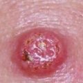 Squamous Cell Carcinoma