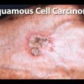 Squamous Cell Carcinoma