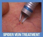 4rejuvadoc-SpiderVein2-58280b5882.jpg